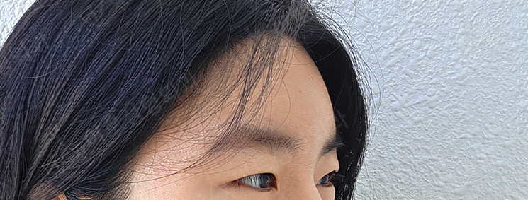 [시술후 7일경과] 이마필러 After