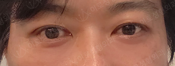 [수술후 30일경과] 시그니처 글로우하안검, 쫀득착붙 매몰 After