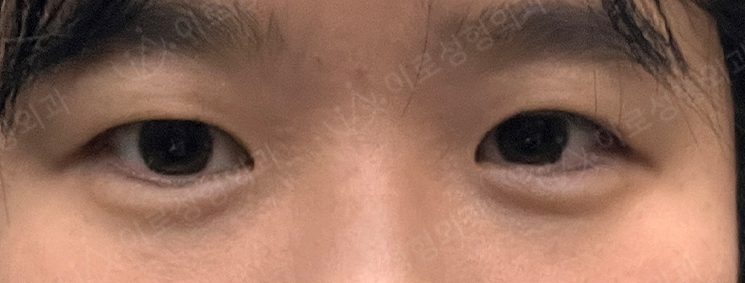 [수술후 30일경과] 부분절개,지방제거,앞트임.. Before