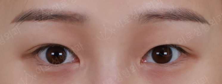[수술후 14일경과] 쫀쫀트임(뒤밑트임) Before