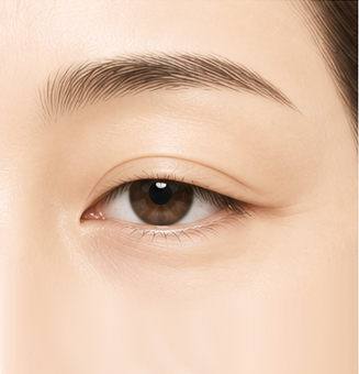 상안검 (피부 절제 + 라인 설계)