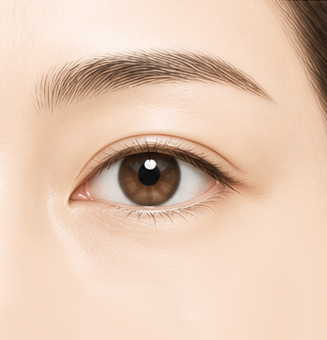 상안검 (눈썹하거상 복합)