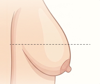 Grade 3 - 심한 처짐