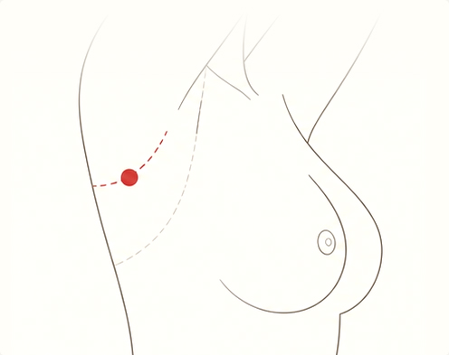 겨드랑이 절개