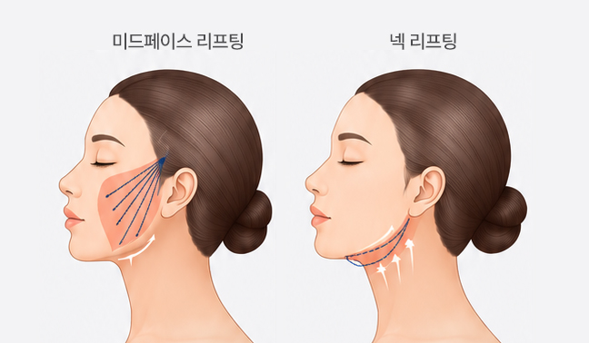 엘라스티꿈